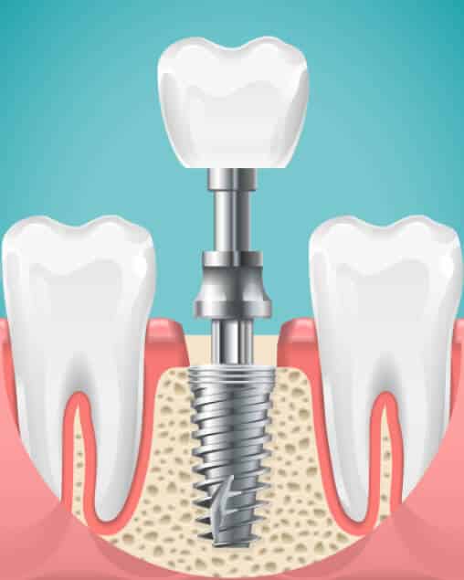 Dental implant diagram showing titanium screw fixture between two natural teeth in gum tissue.