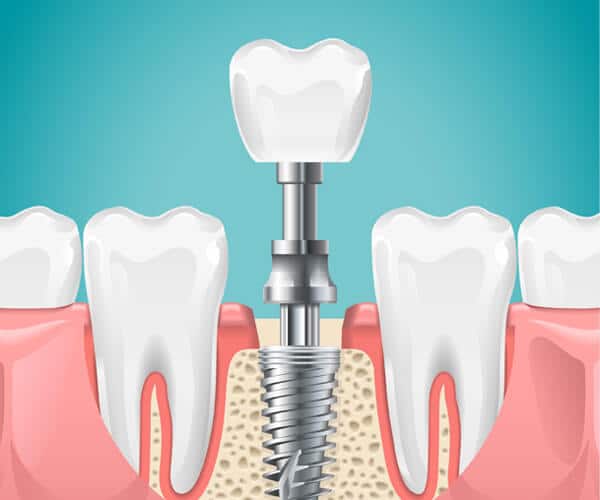 Dental implant diagram showing titanium post anchored in jawbone surrounded by natural teeth and gum tissue.