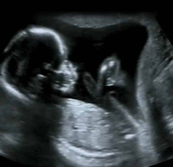 Ultrasound scan showing fetal development in grayscale during pregnancy imaging.