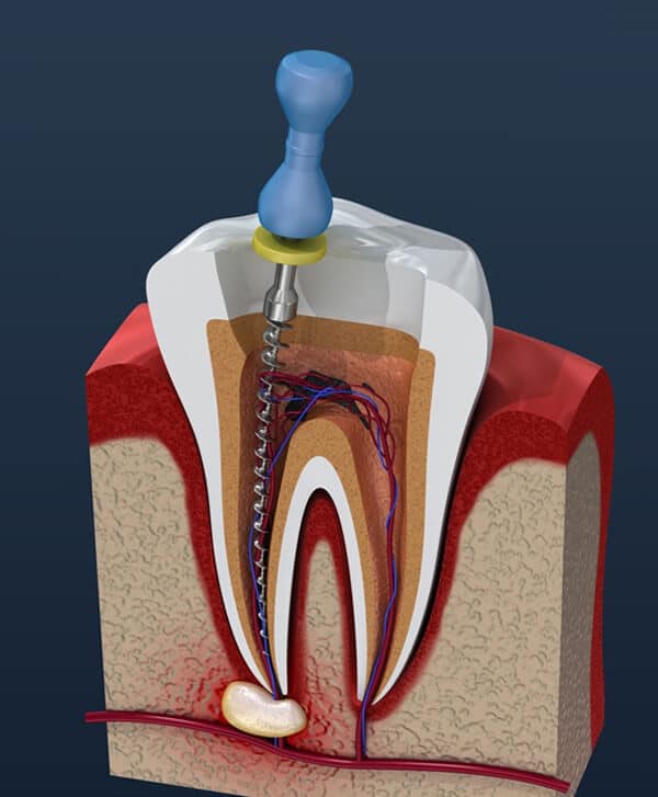 Dental cross-section model showing tooth anatomy with pulp chamber, root canal, and surrounding bone structure.
