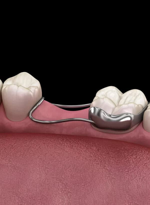 Dental bridge connecting two teeth with metal framework on pink gum model background.