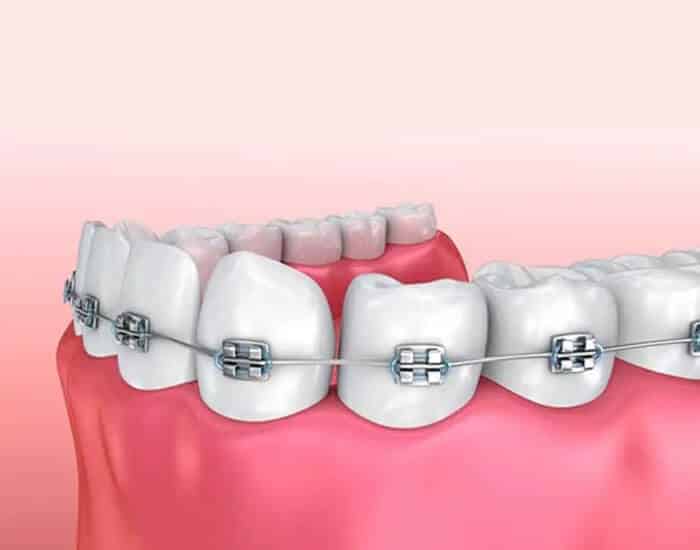 Close-up of dental braces on upper teeth showing metal brackets and wires against pink gum background.